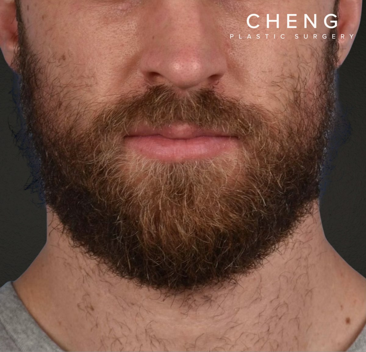 Hair Transplant With NeoGraft Before & After Gallery - Patient 326874 - Image 4