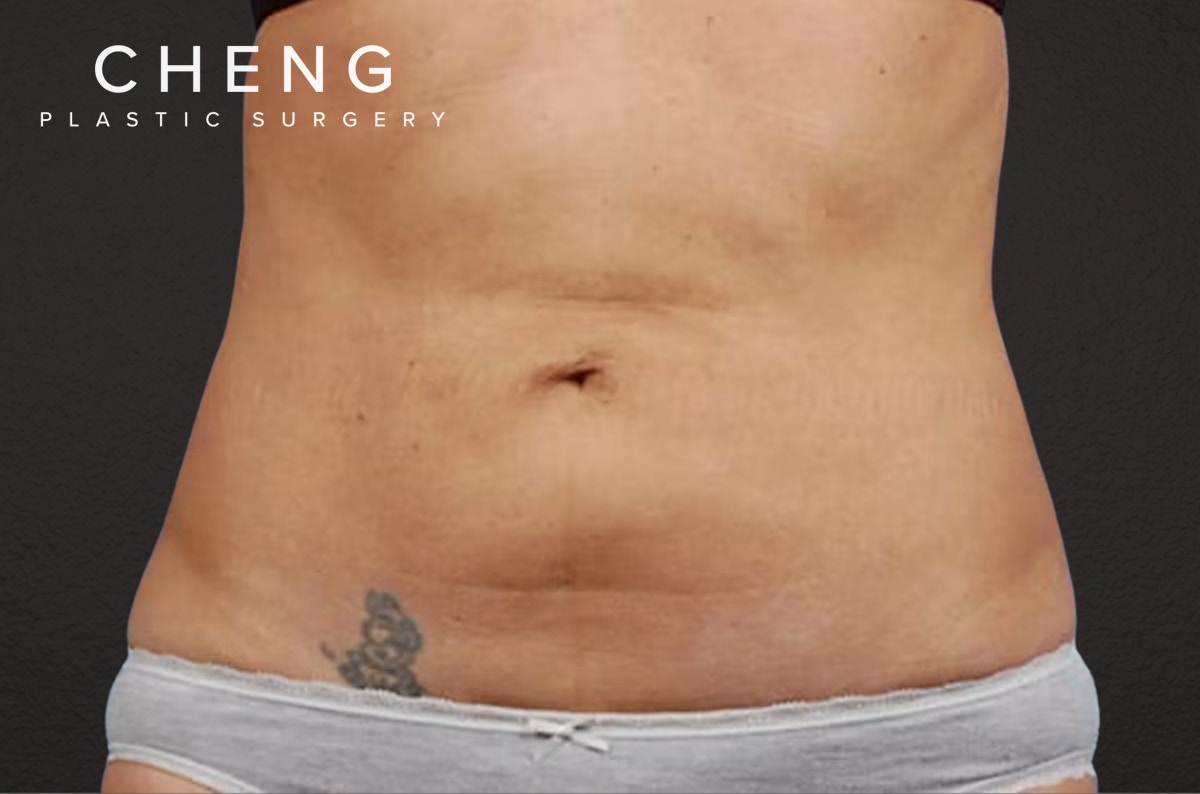 Liposuction Before & After Gallery - Patient 290094 - Image 1