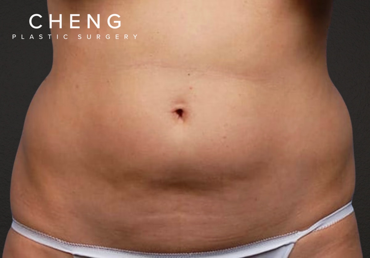 Liposuction Before & After Gallery - Patient 406129 - Image 1