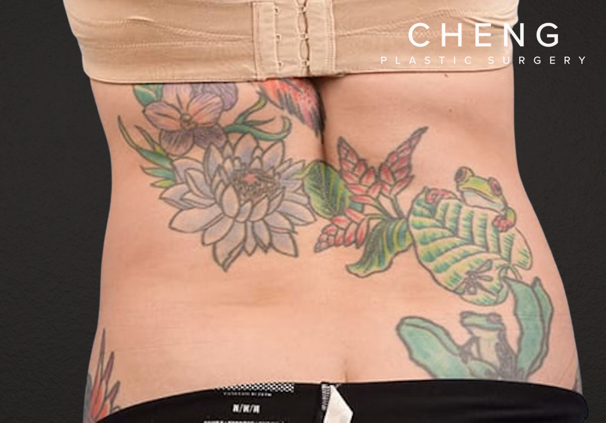 Liposuction Before & After Gallery - Patient 301902 - Image 8