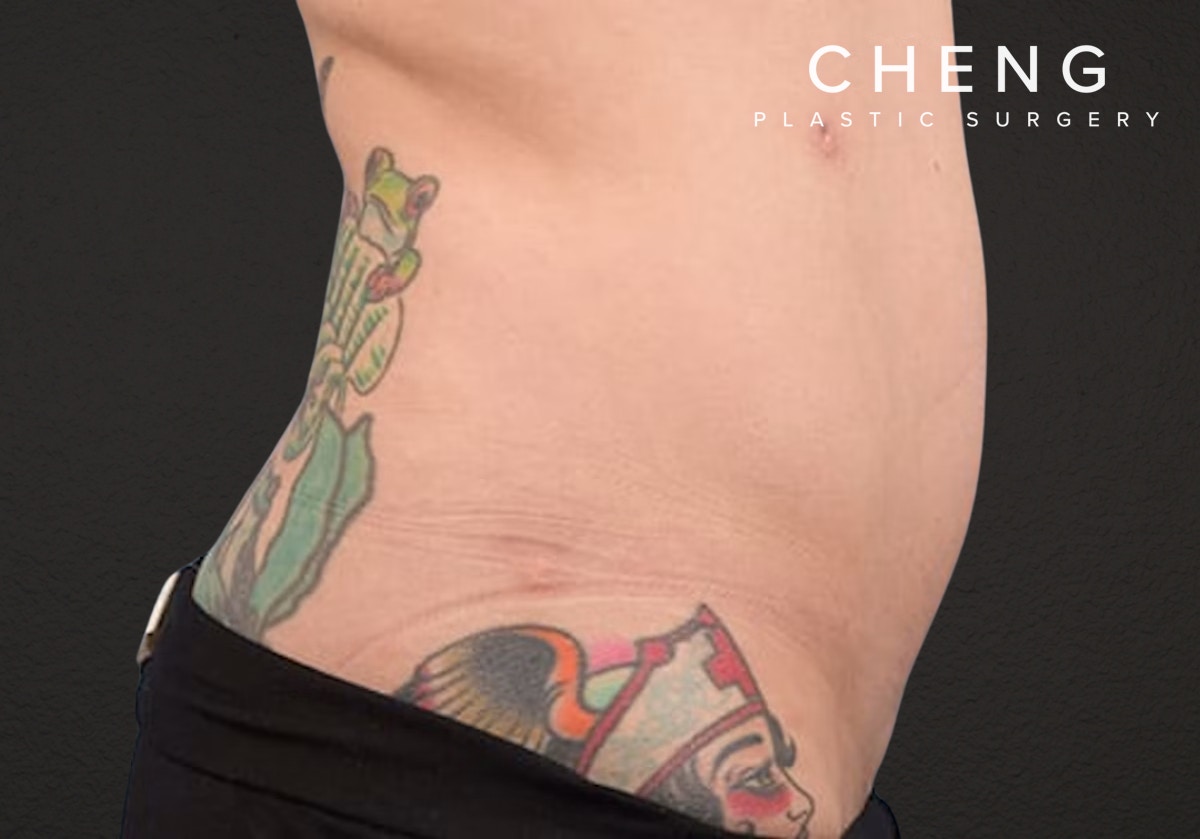 Liposuction Before & After Gallery - Patient 301902 - Image 6