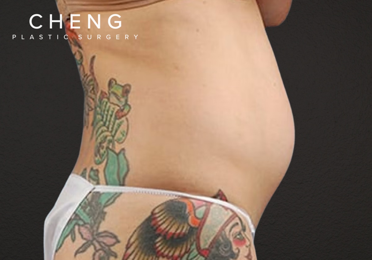 Liposuction Before & After Gallery - Patient 301902 - Image 5
