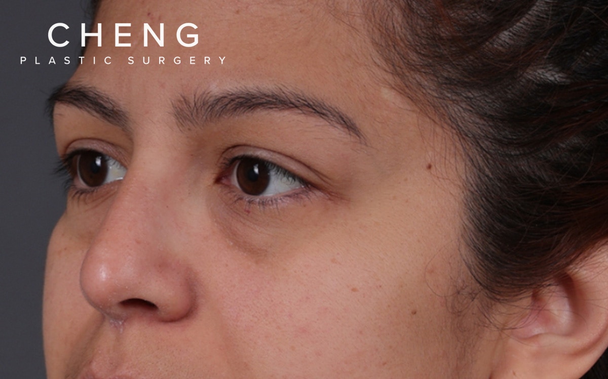 Blepharoplasty Before & After Gallery - Patient 228493 - Image 5