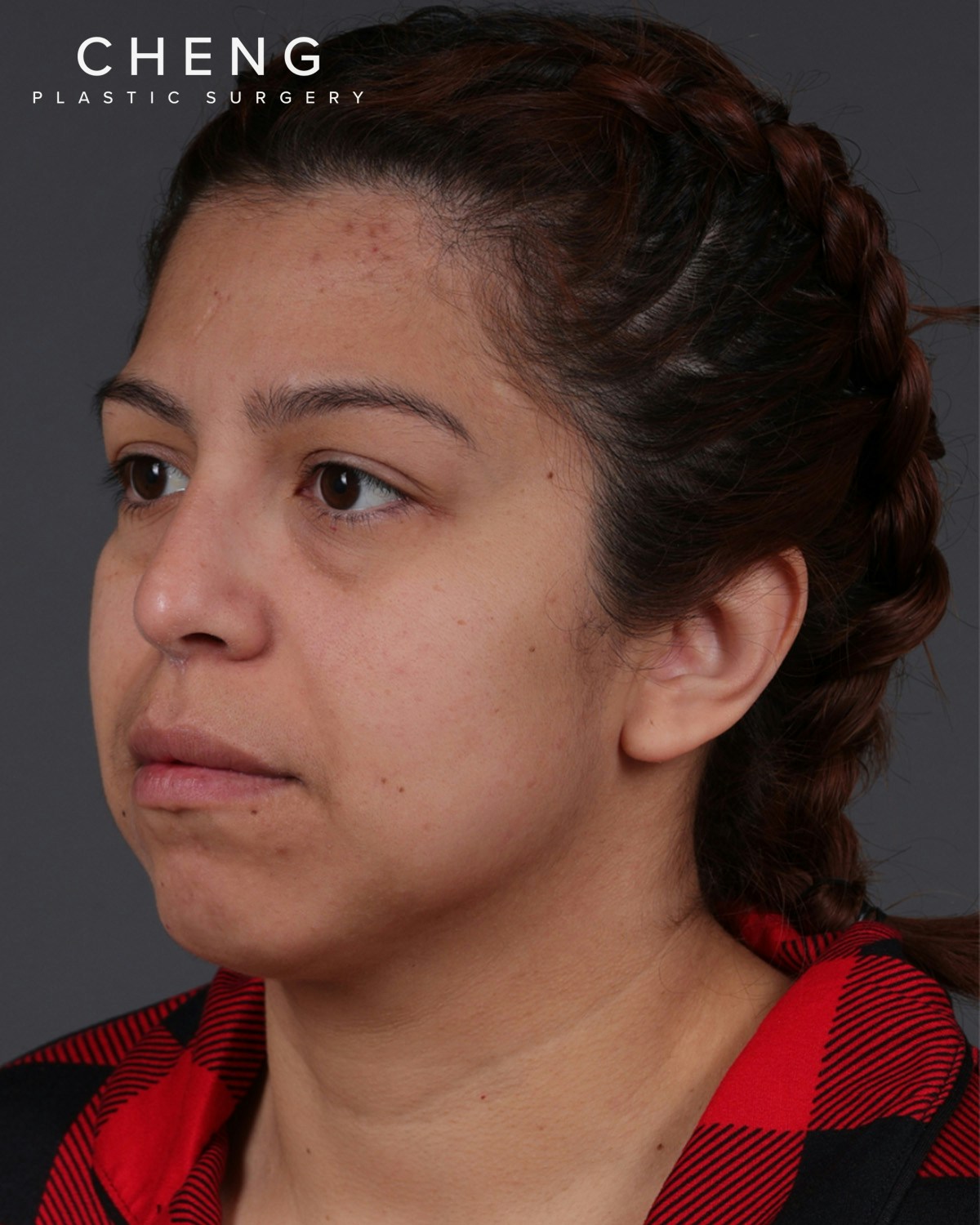 Fat Grafting Before & After Gallery - Patient 397263 - Image 5