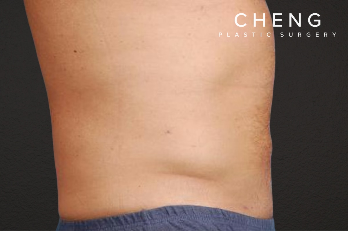 Liposuction Before & After Gallery - Patient 135889 - Image 2