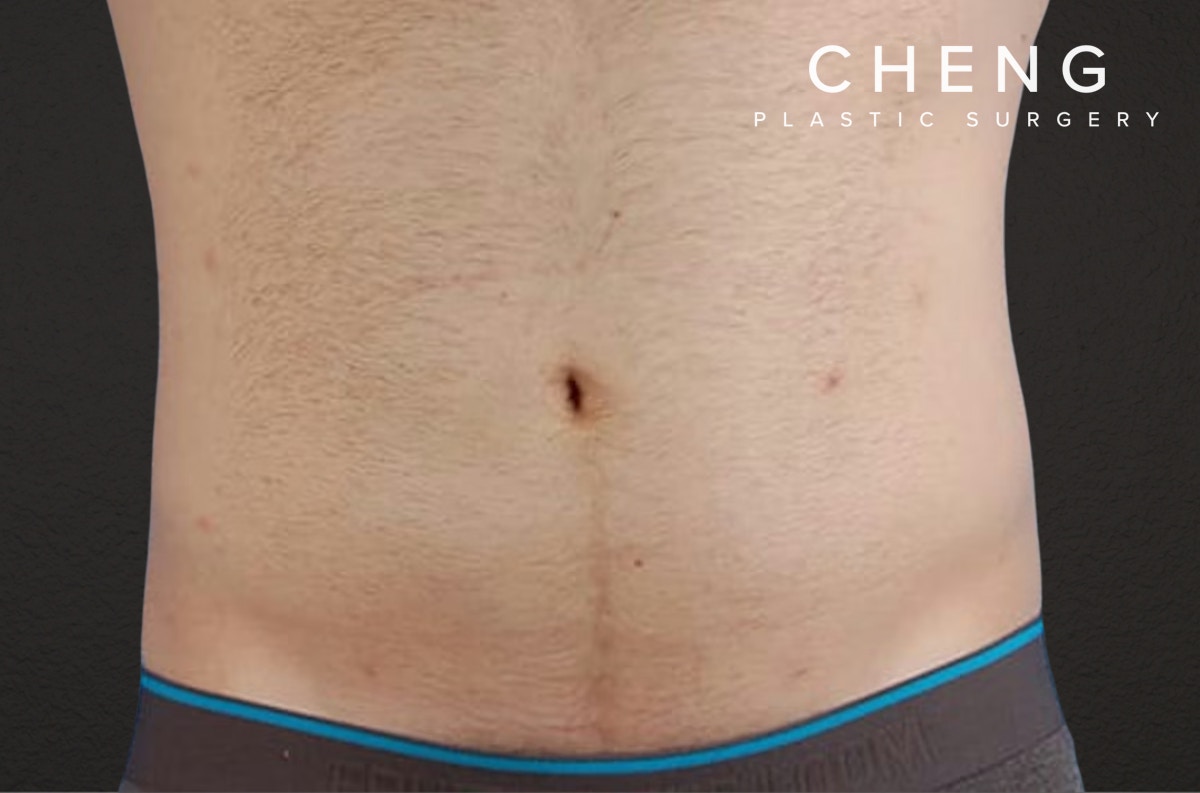 Liposuction Before & After Gallery - Patient 333626 - Image 2