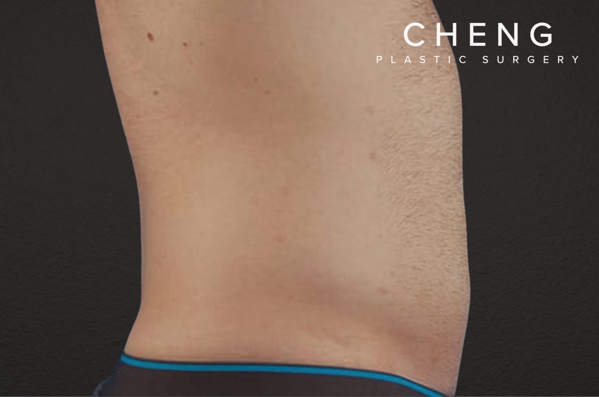 Liposuction Before & After Gallery - Patient 333626 - Image 6