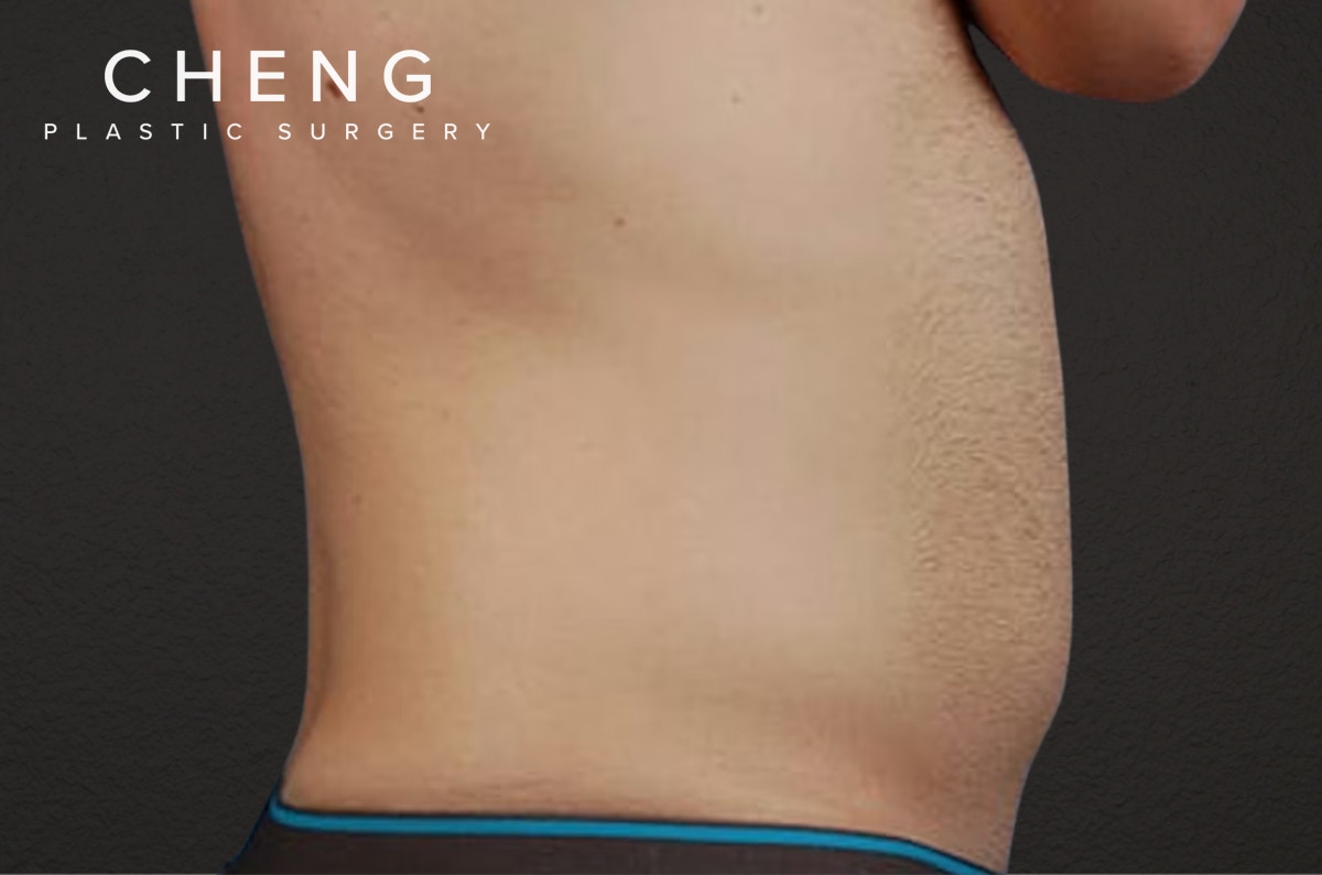 Liposuction Before & After Gallery - Patient 333626 - Image 5