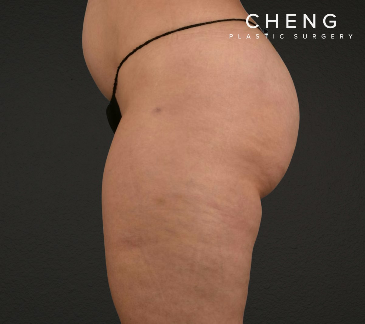 Liposuction Before & After Gallery - Patient 464332 - Image 4