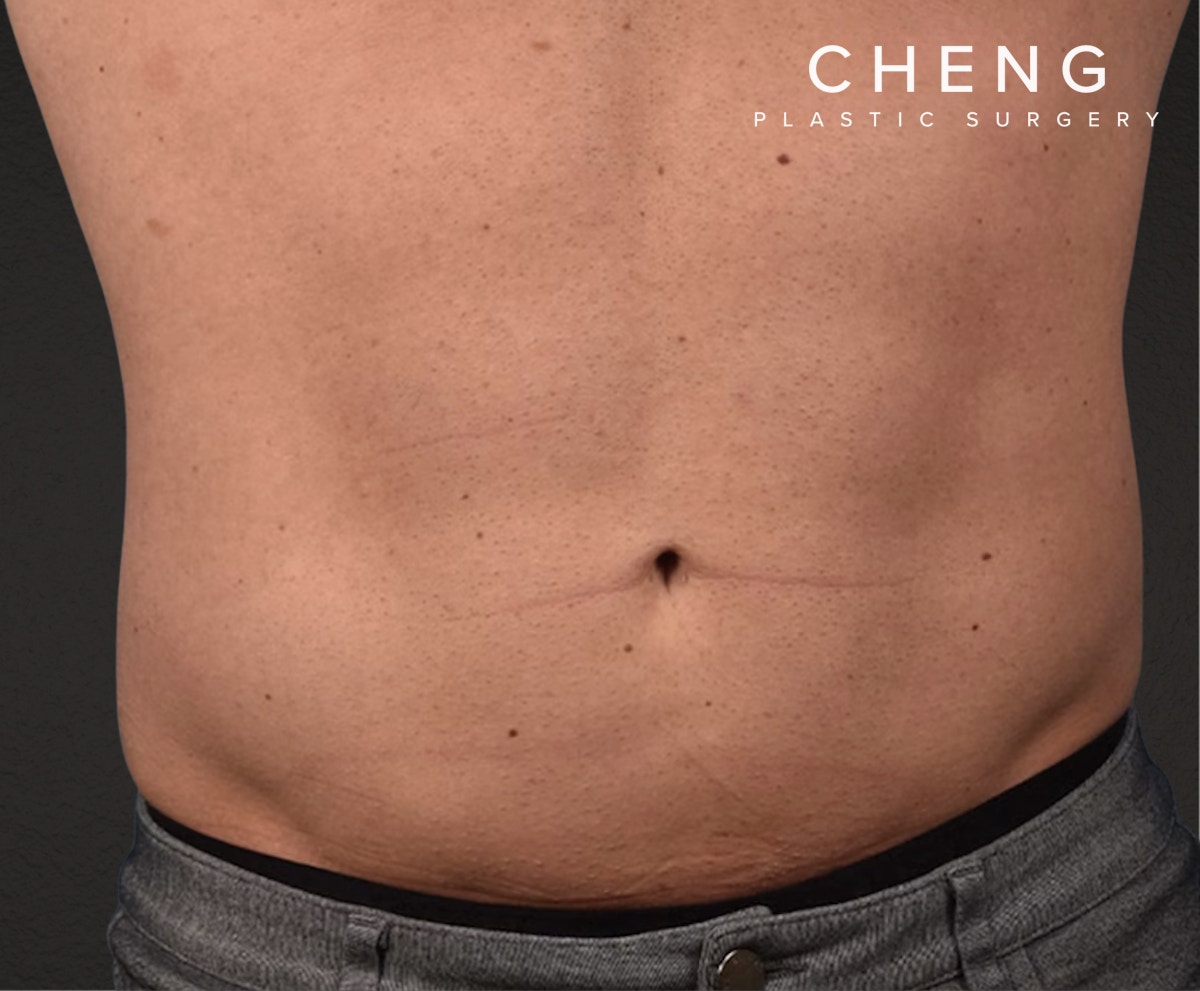 Liposuction Before & After Gallery - Patient 267185 - Image 2