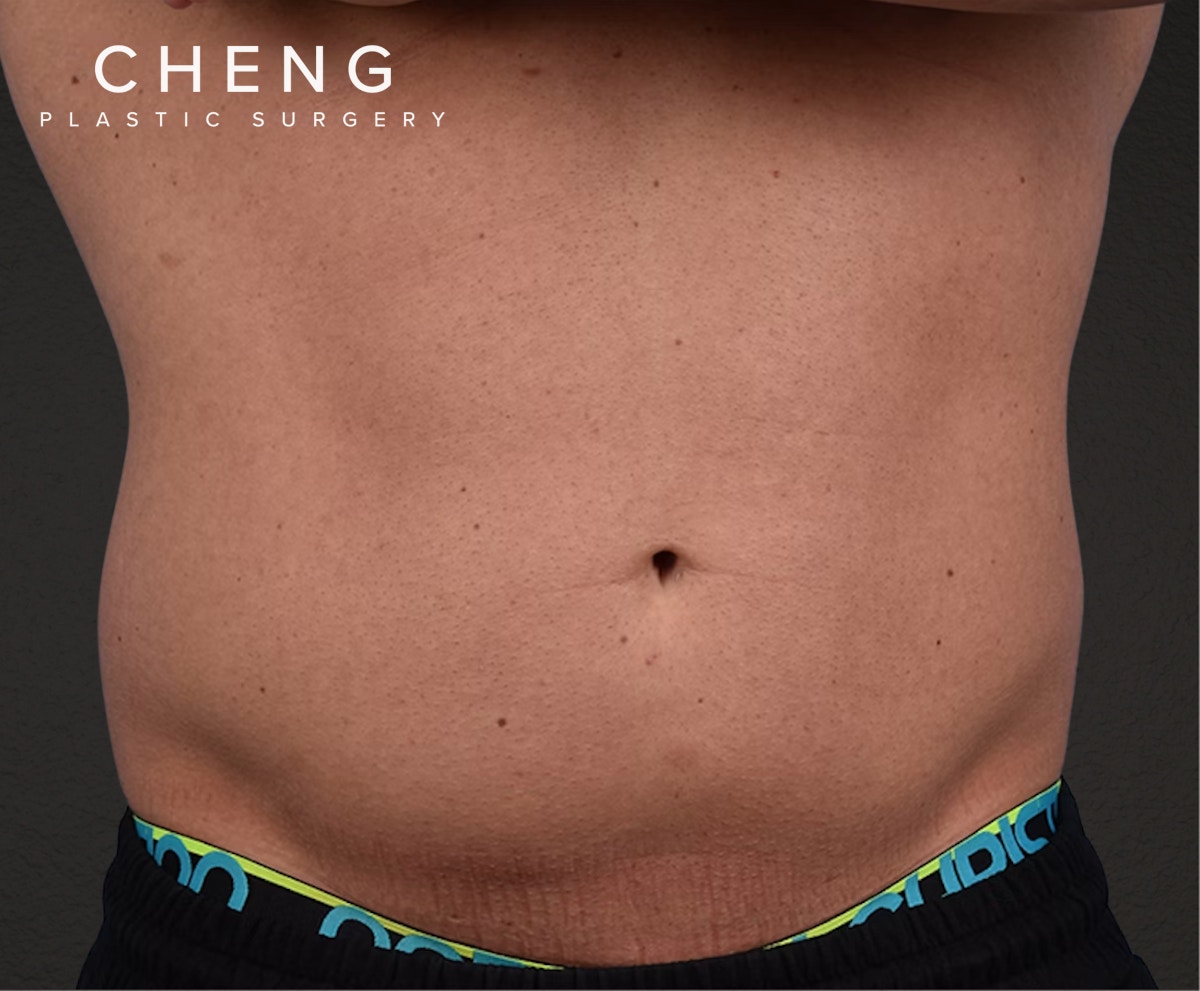 Liposuction Before & After Gallery - Patient 267185 - Image 1