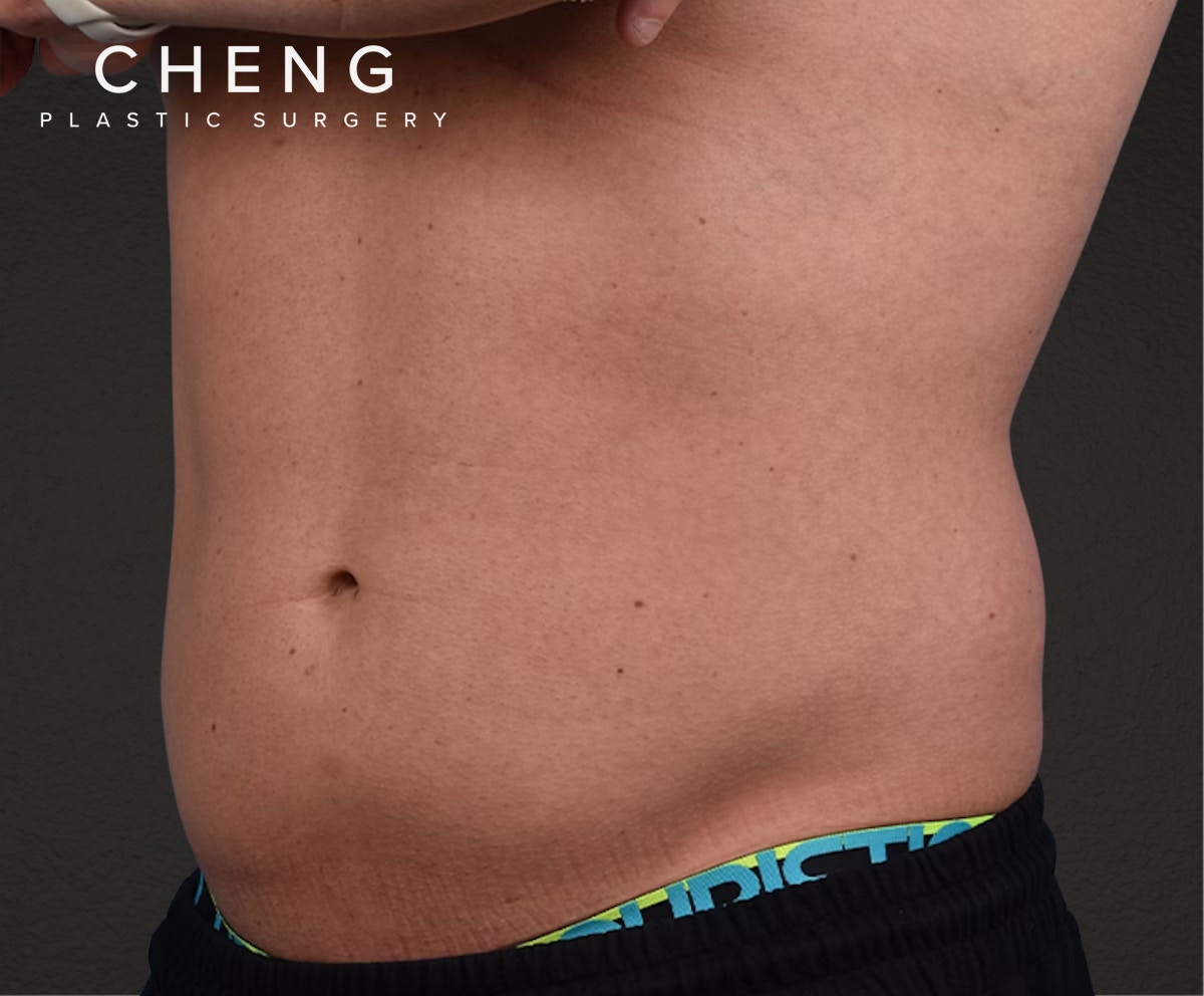 Liposuction Before & After Gallery - Patient 267185 - Image 3