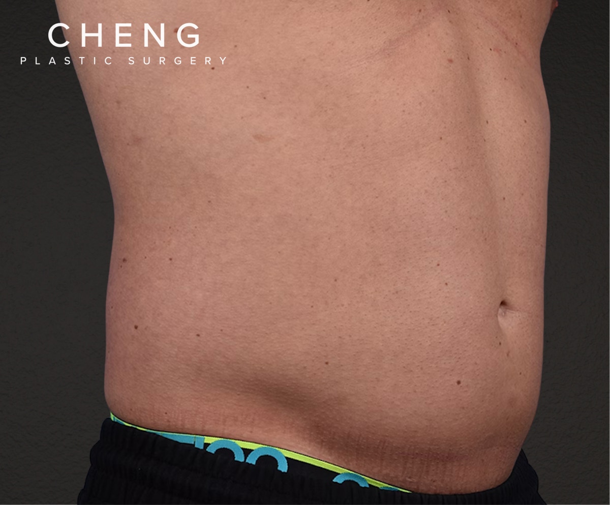 Liposuction Before & After Gallery - Patient 267185 - Image 5