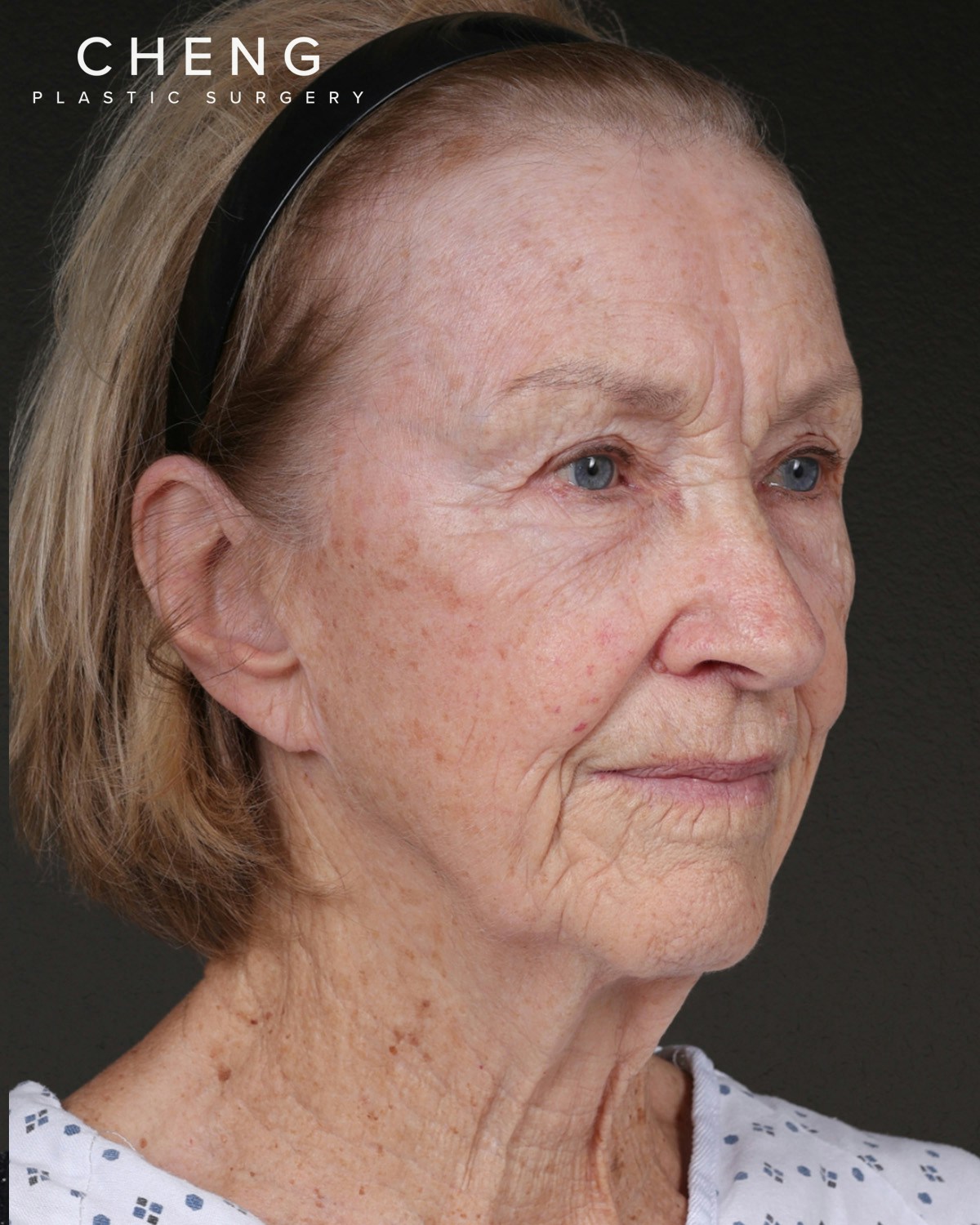 Neck Lift Before & After Gallery - Patient 244408 - Image 1