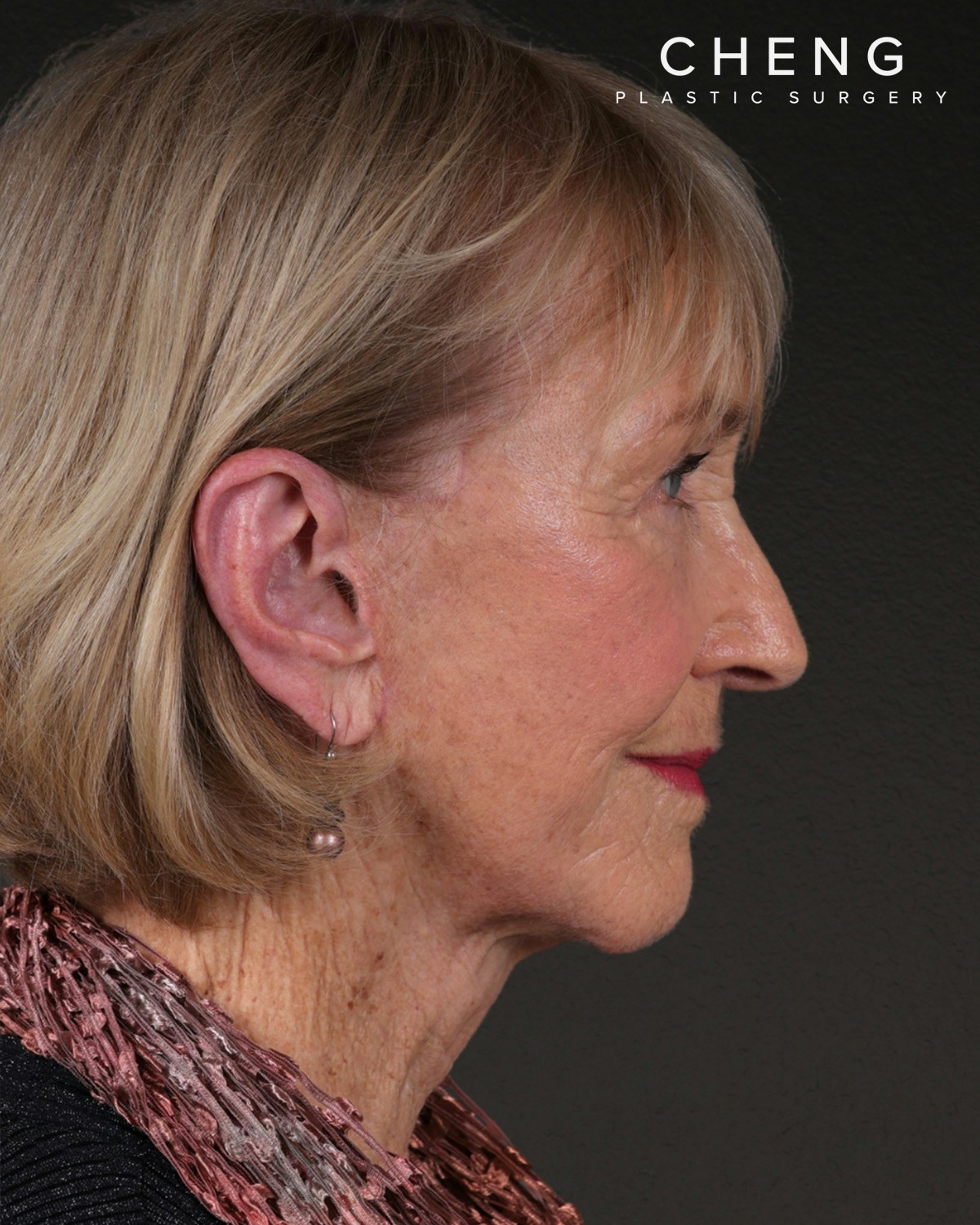 Neck Lift Before & After Gallery - Patient 244408 - Image 6