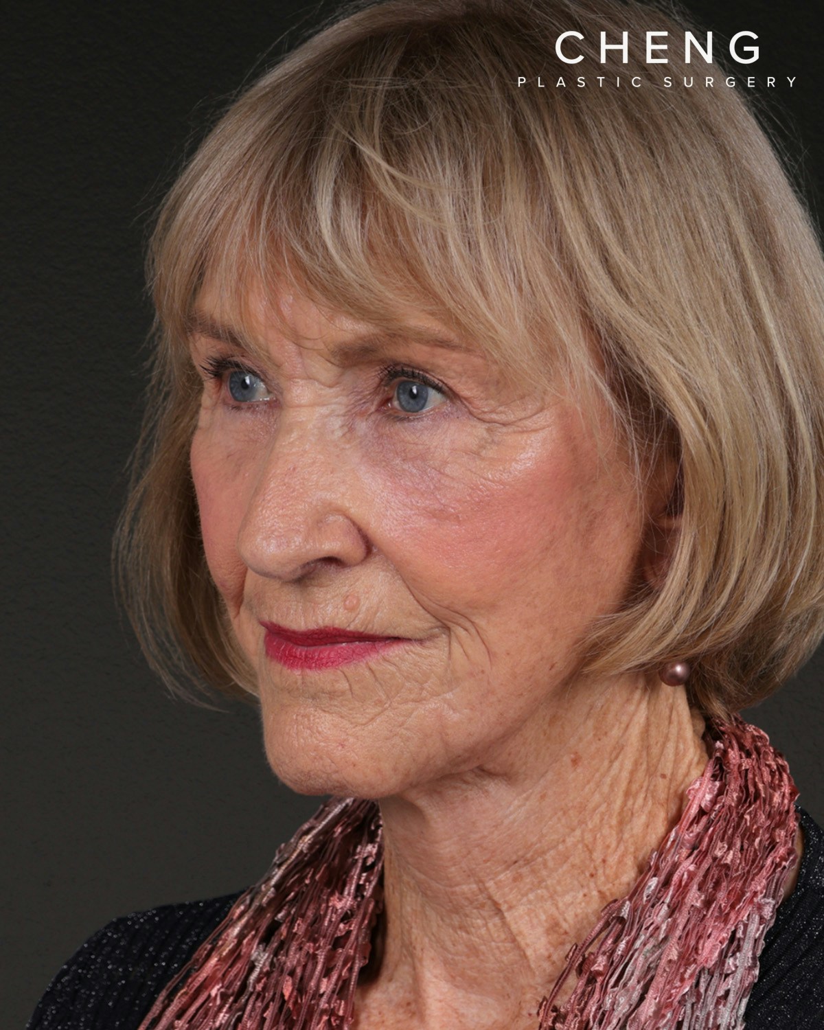 Neck Lift Before & After Gallery - Patient 244408 - Image 8