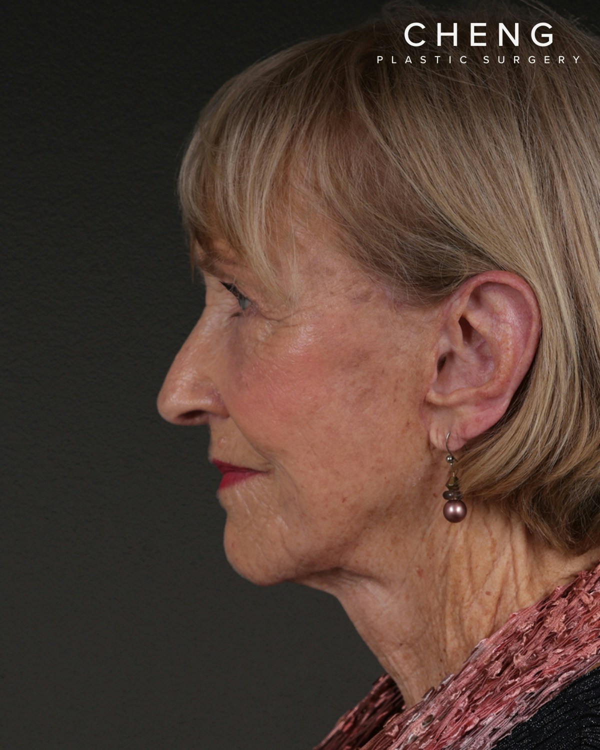 Neck Lift Before & After Gallery - Patient 244408 - Image 10