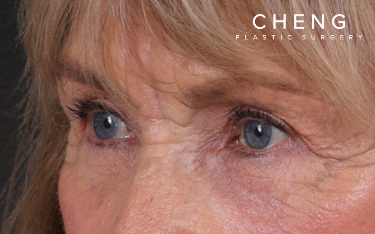 Blepharoplasty Before & After Gallery - Patient 162903 - Image 8