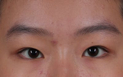 Blepharoplasty Before & After Gallery - Patient 308998 - Image 1