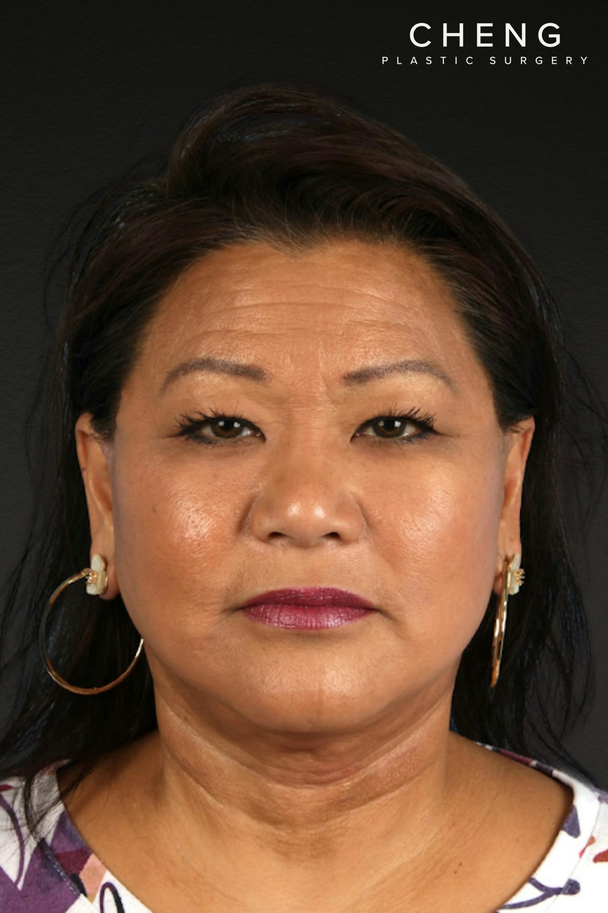 Renuvion Before & After Gallery - Patient 125918 - Image 2