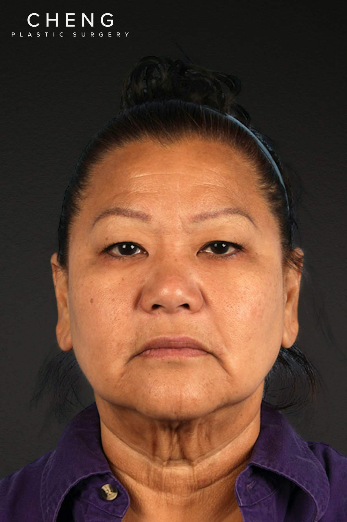 Renuvion Before & After Gallery - Patient 125918 - Image 1