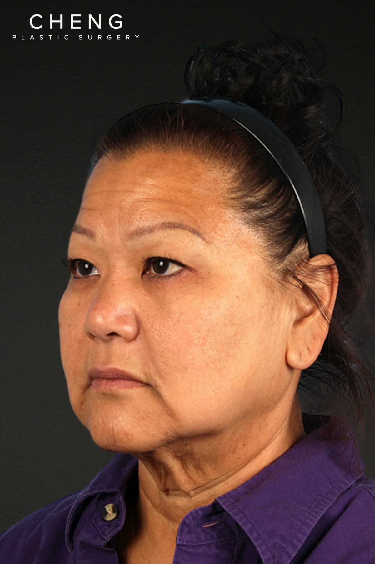 Renuvion Before & After Gallery - Patient 125918 - Image 5