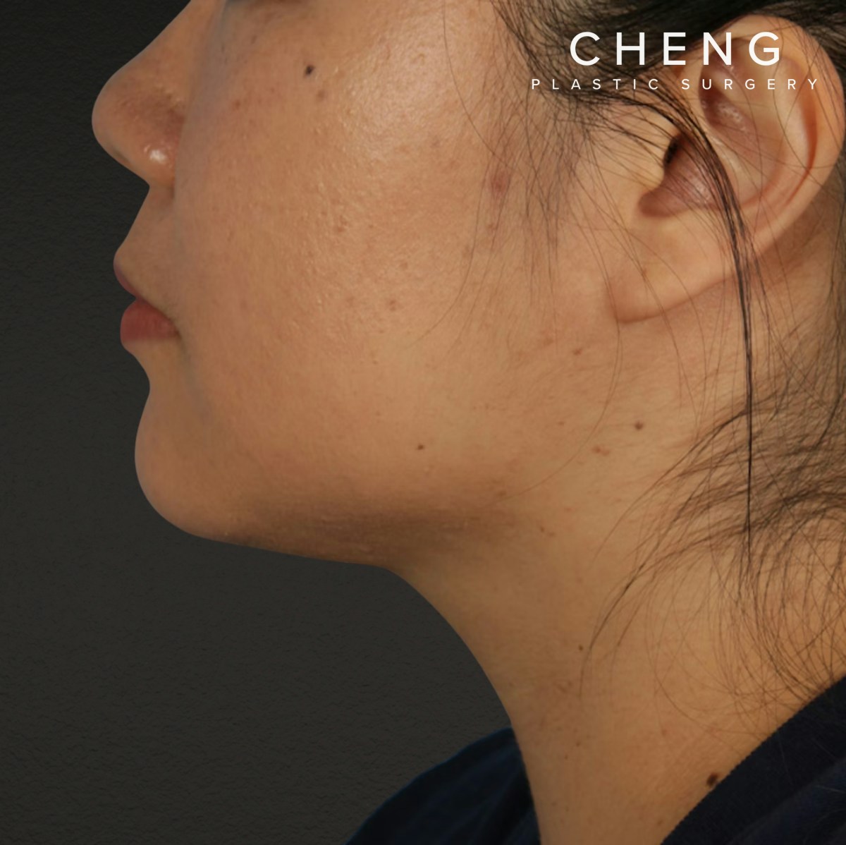 Renuvion Before & After Gallery - Patient 296884 - Image 2