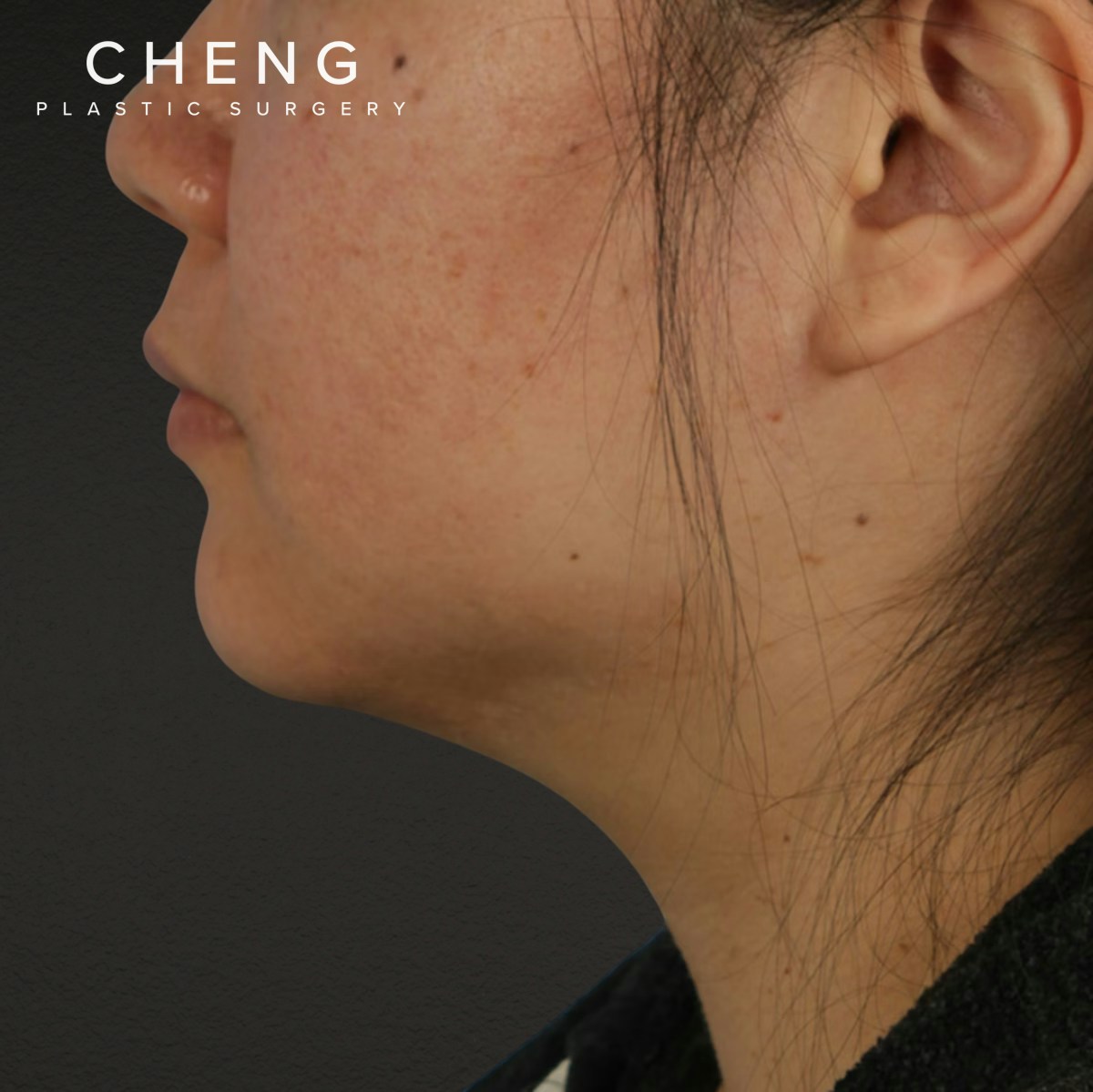 Renuvion Before & After Gallery - Patient 296884 - Image 1