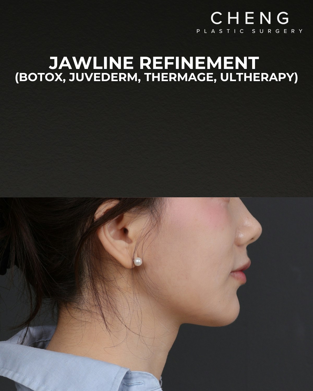 Thermage FLX Before & After Gallery - Patient 265507 - Image 4