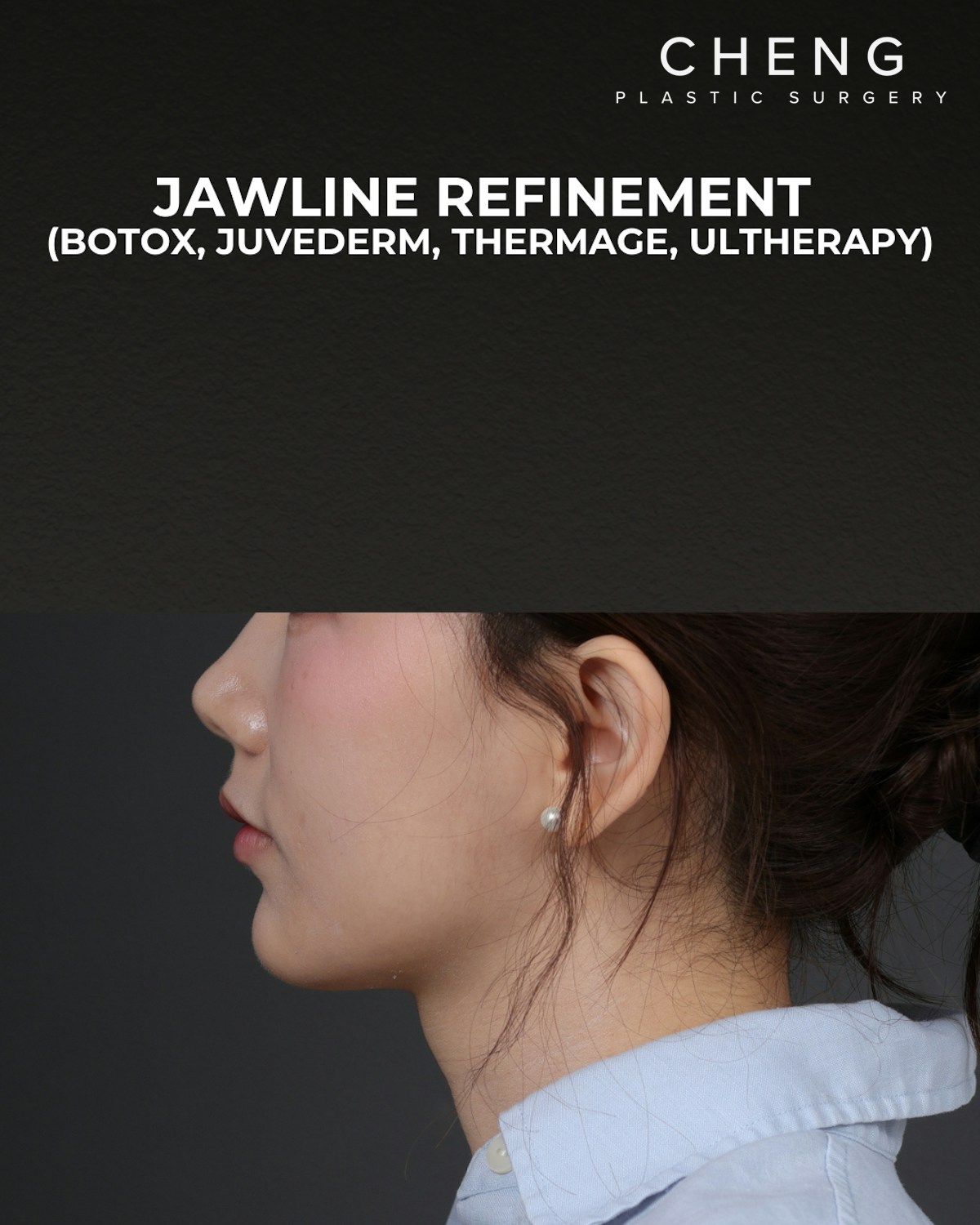 Thermage FLX Before & After Gallery - Patient 265507 - Image 8