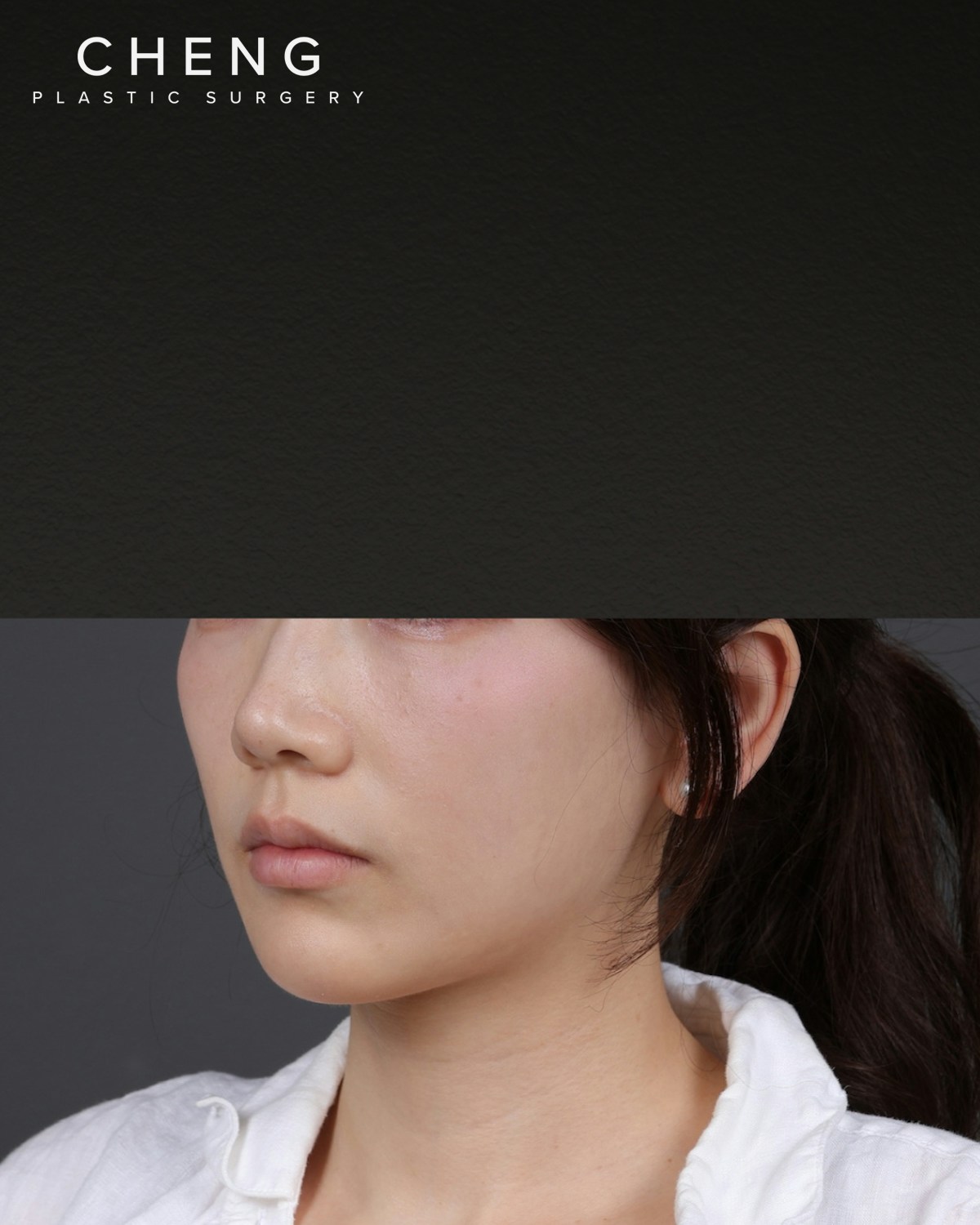 Thermage FLX  Before & After Gallery - Patient 265507 - Image 5