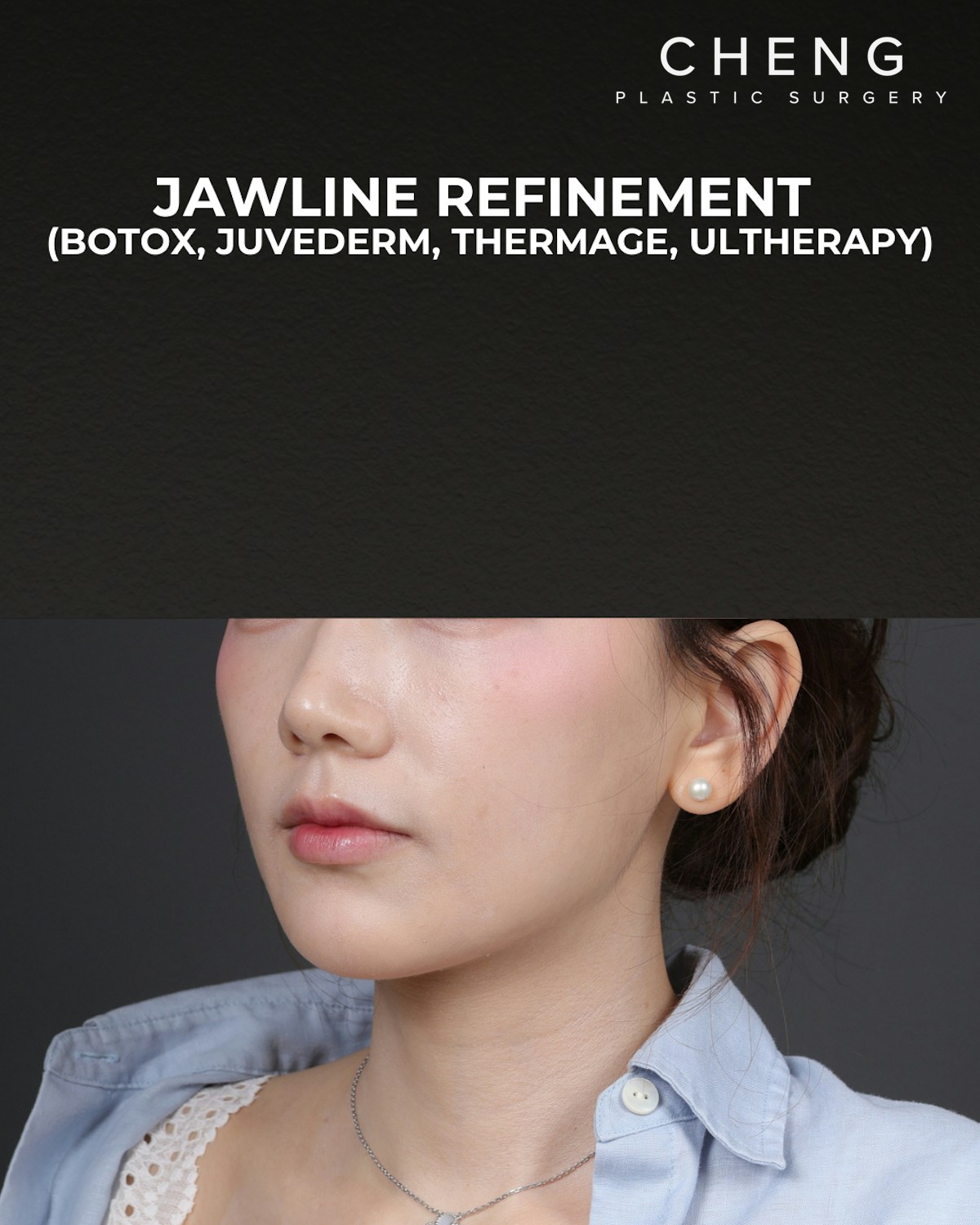 Thermage FLX  Before & After Gallery - Patient 265507 - Image 6
