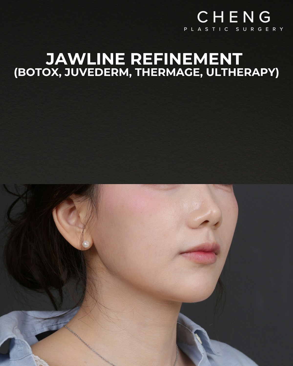 Thermage FLX  Before & After Gallery - Patient 265507 - Image 2