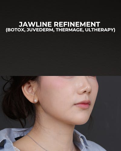 Dermal Fillers Before & After Gallery - Patient 320376 - Image 2