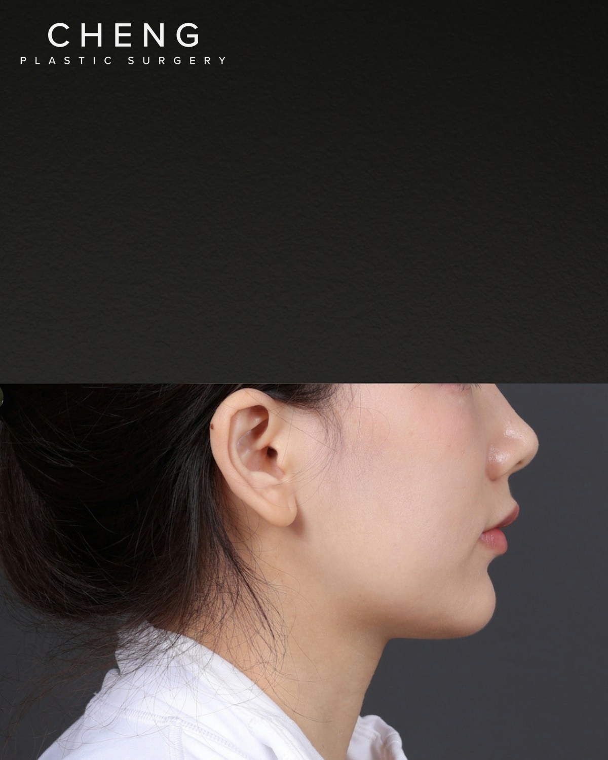 Thermage FLX  Before & After Gallery - Patient 265507 - Image 3