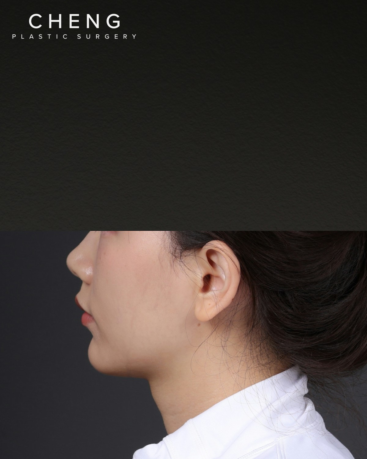 Thermage FLX  Before & After Gallery - Patient 265507 - Image 7