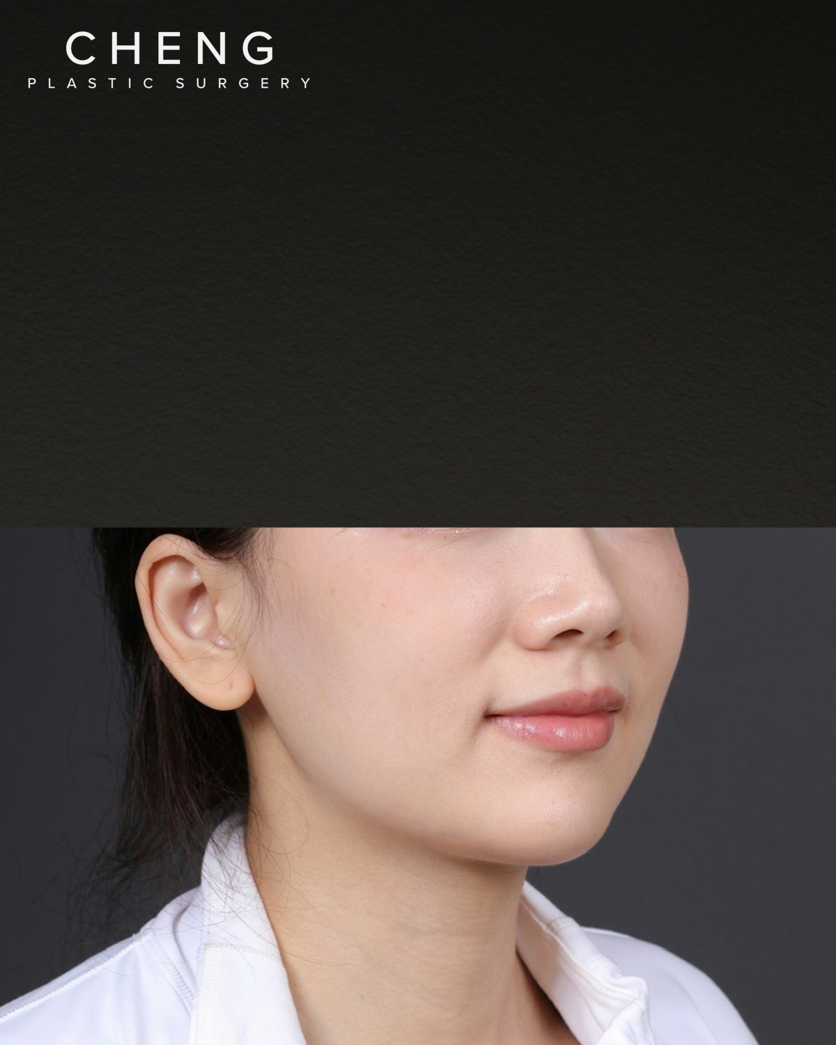 Thermage FLX  Before & After Gallery - Patient 265507 - Image 1