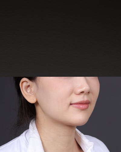 Dermal Fillers Before & After Gallery - Patient 320376 - Image 1