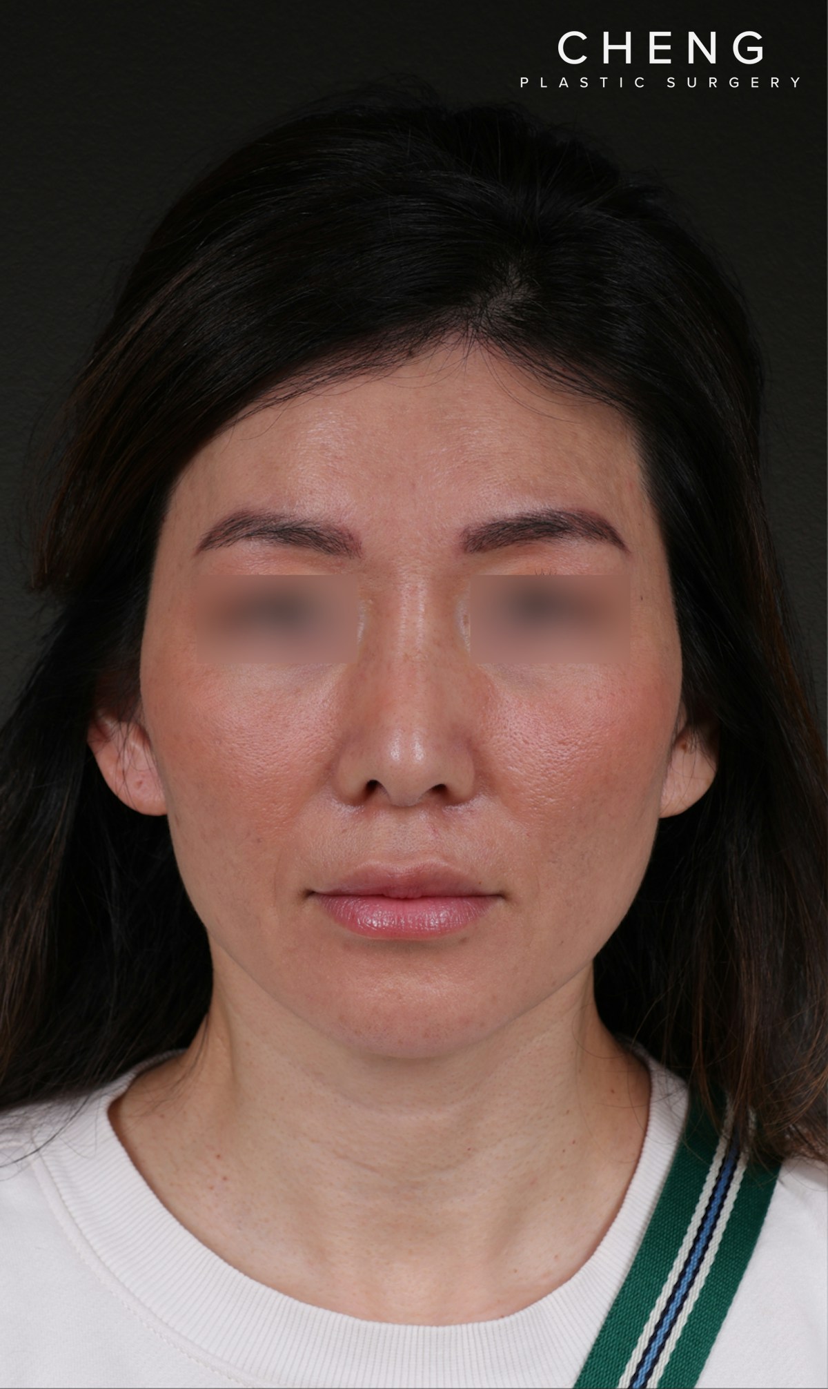 Fat Grafting Before & After Gallery - Patient 320694 - Image 2