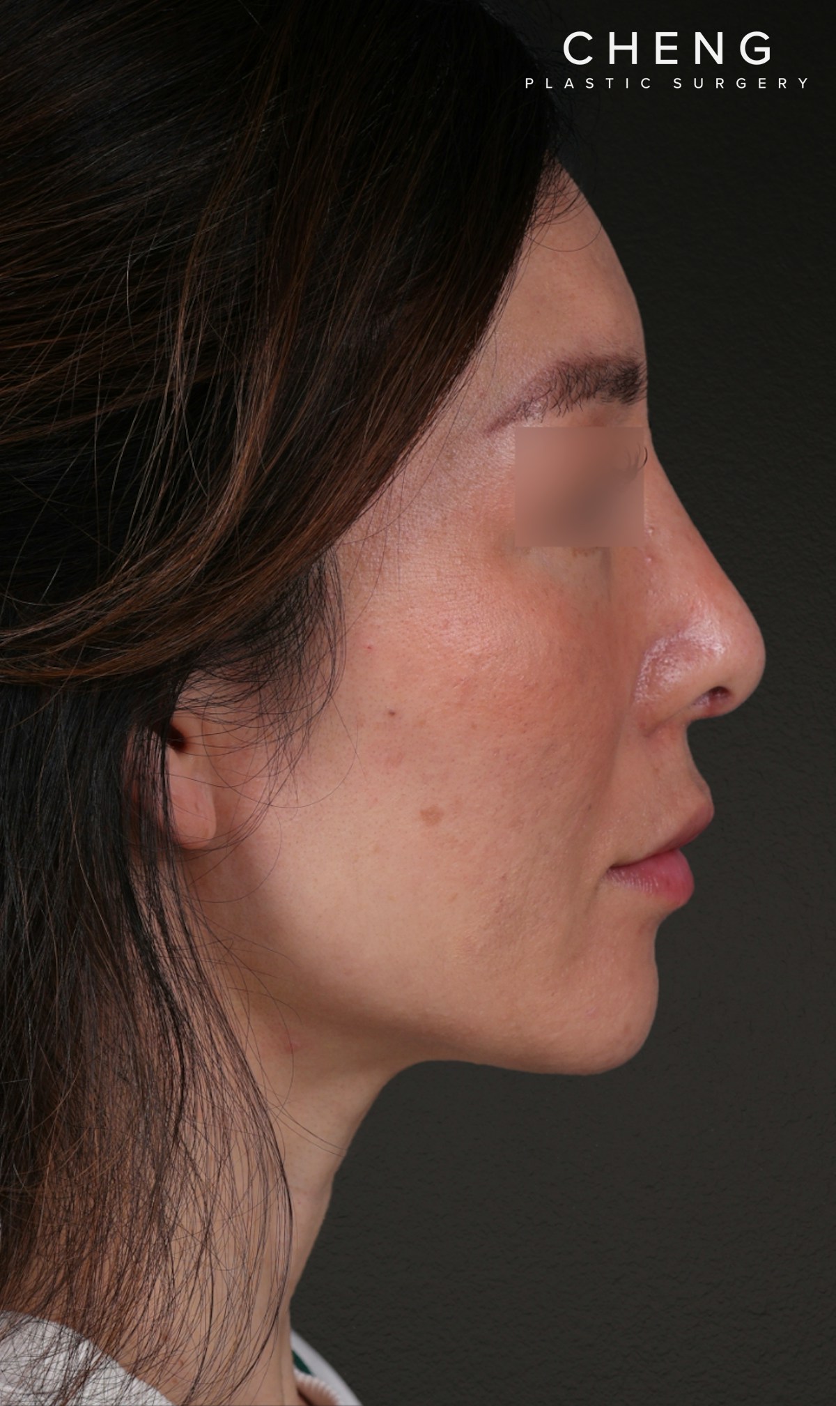 Fat Grafting Before & After Gallery - Patient 320694 - Image 6