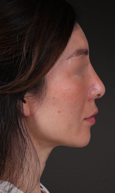 Rhinoplasty Before & After Gallery - Patient 337080 - Image 2