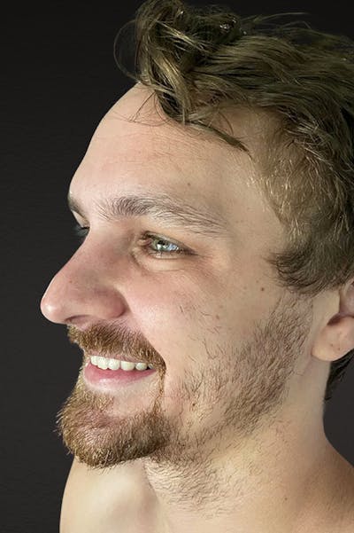 Botox and Dysport Before & After Gallery - Patient 404936 - Image 2