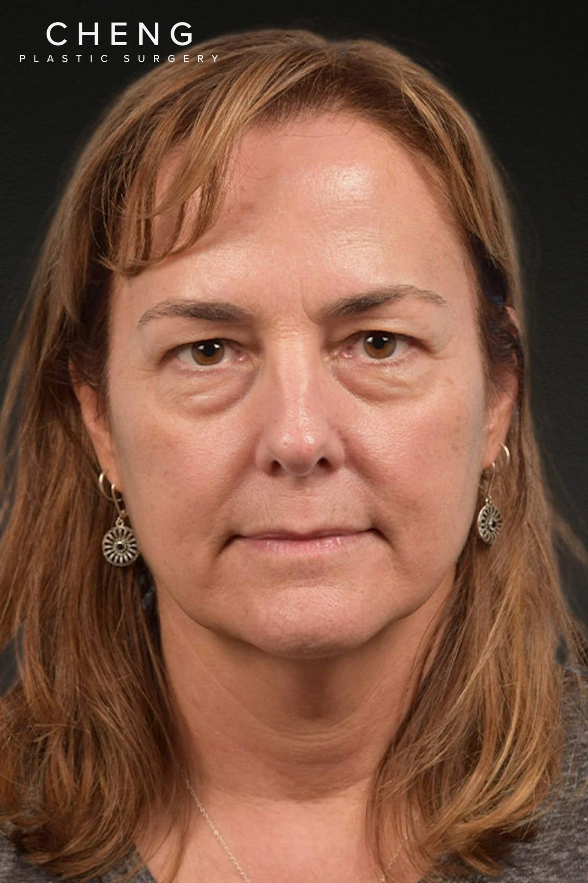 Botox and Dysport Before & After Gallery - Patient 426304 - Image 1