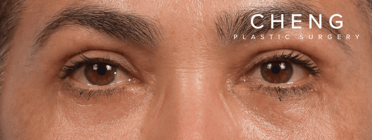 Blepharoplasty Before & After Gallery - Patient 107482 - Image 2