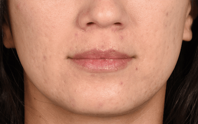 Hidden Patients Before & After Gallery - Patient 337844 - Image 1