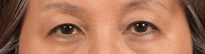 Hidden Patients Before & After Gallery - Patient 947245 - Image 2