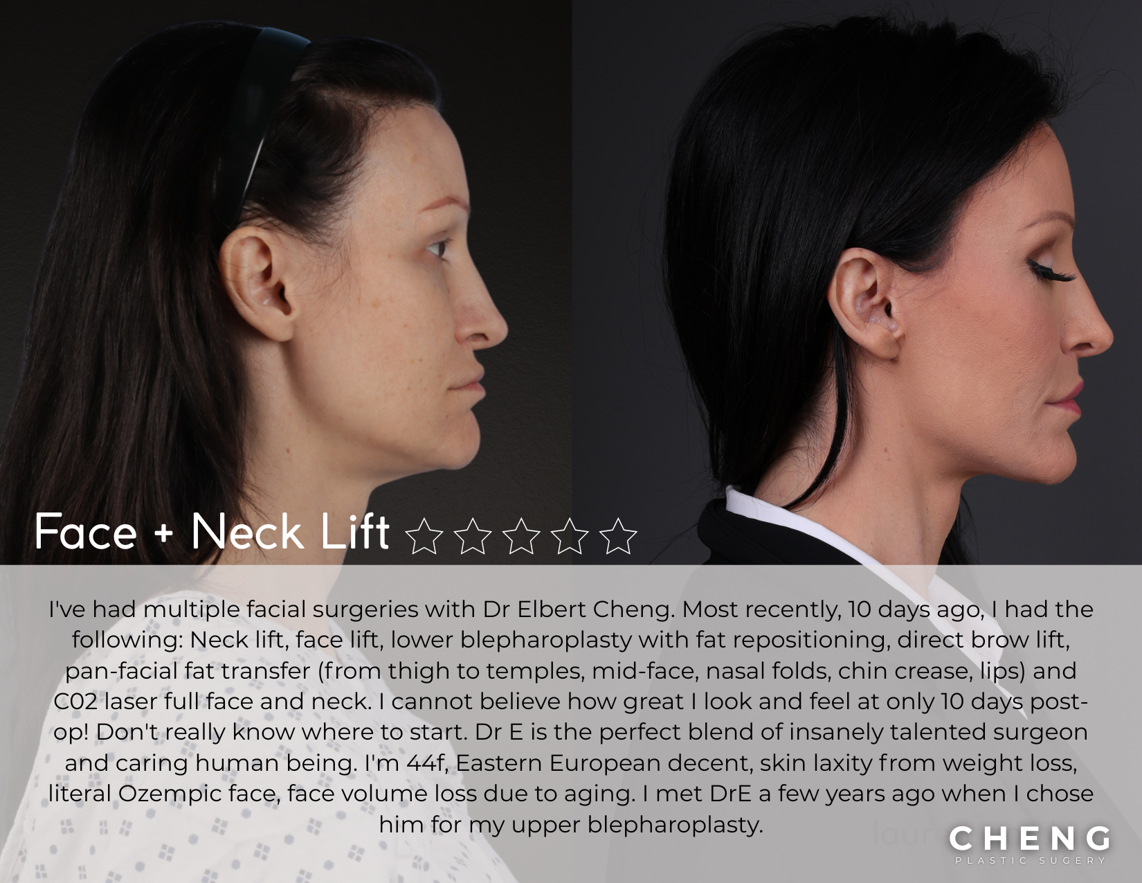 before and after face lift