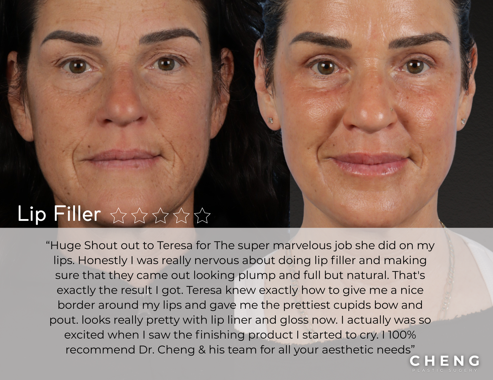 before and after lip filler